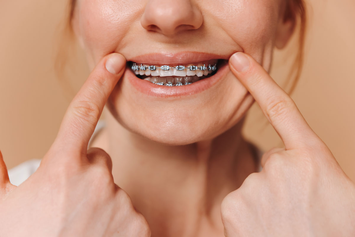 Avantajele și dezavantajele aparatelor dentare fixe